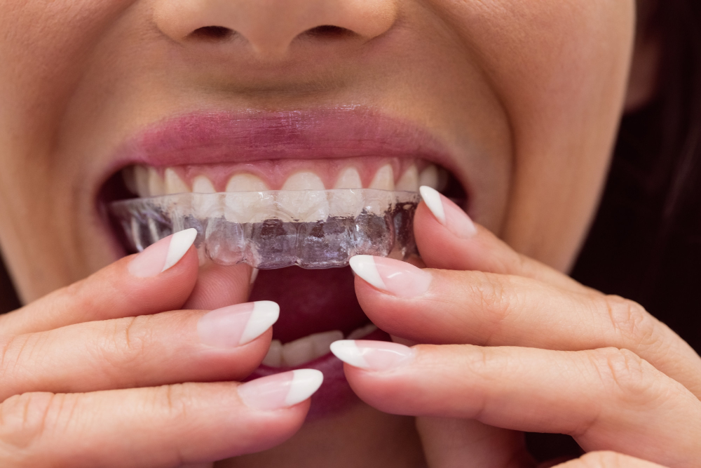 Invisible braces
